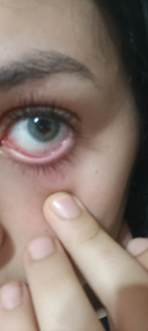 İlk defa lens taktım gözüm çok kötü durumda neden?