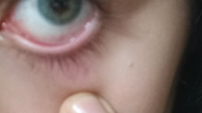 İlk defa lens taktım gözüm çok kötü durumda neden?
