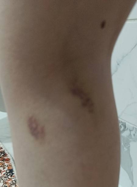 Aniden oluşan morluk sebepleri nedir?