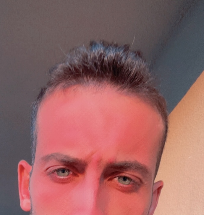 Göz altı morluklar ve göz torbacığı için ne yapmalıyım?