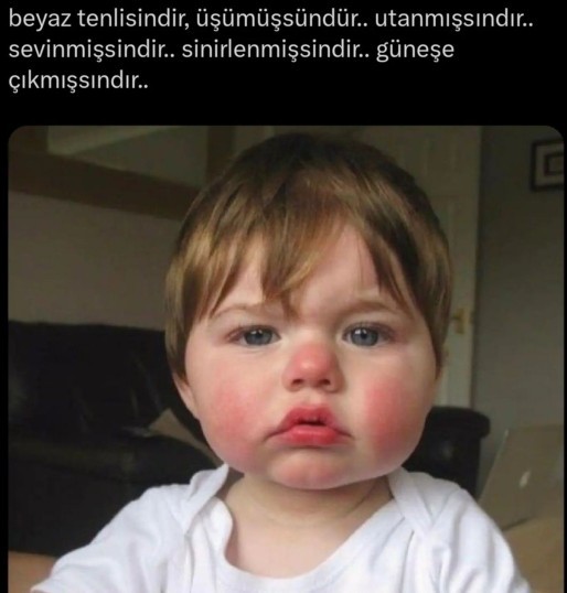 Cildiniz en ufak temasta kızaracak kadar hassas mıdır?