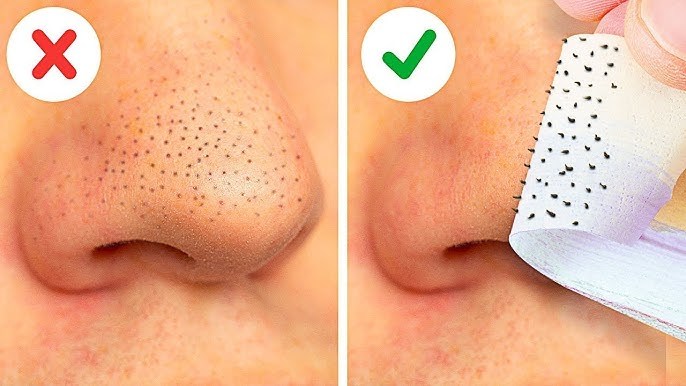 Siyah noktalar için en iyi çözümün nedir?