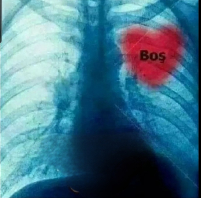 Bugün çekilen röntgenim🤭yaniii... bilmem anlatabildim mi🤭🤭🤭daha napayım?🤭🤭🤭?