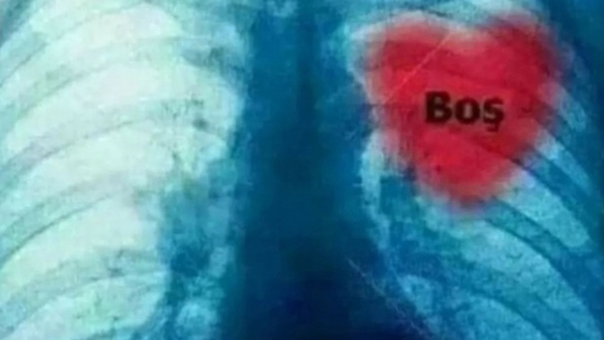 Bugün çekilen röntgenim🤭yaniii... bilmem anlatabildim mi🤭🤭🤭daha napayım?🤭🤭🤭?