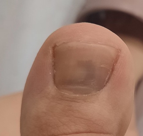 Tırnak içindeki bu morluk nasıl geçer?