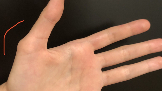 Baş parmağımdaki bu kemik çıkıntısının düzelme ihtimali var mı bir şekilde? normal mi bu yani çoğu insana bakıyorum çıkıntı yok?