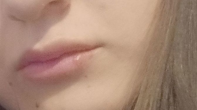 Arkadaslar alt dudagimda uçuk cikmis cok canimi yakiyor bunu nasil gecirebilirim evde veya bildiginiz ucuk kremi varmı🥲?