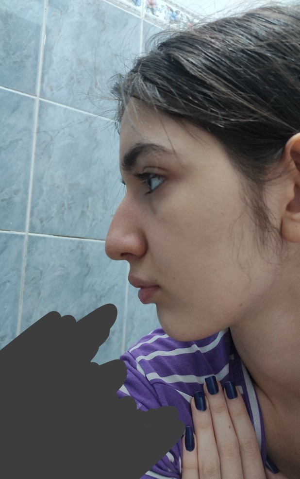 Burun estetiği ameliyatı olacağım sizce bana düz bir burun gidermi?