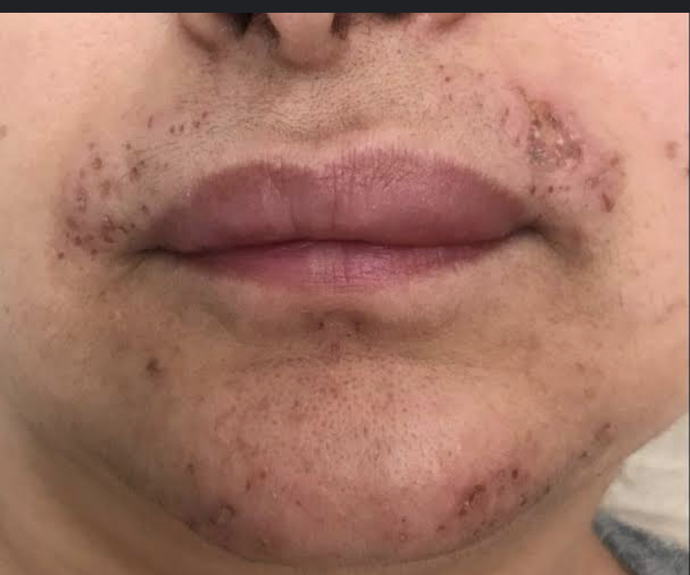 Yüzümde aşırı tuylenme var normal buzlu lazere gittim geçmedi igneli epilasyona gidersem işe yarar mı?