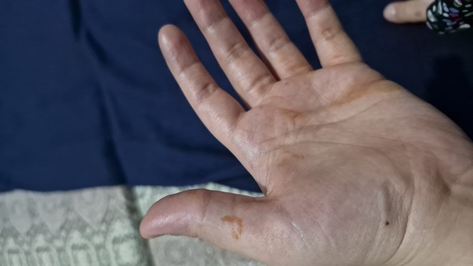 Bu lekeler nedir?