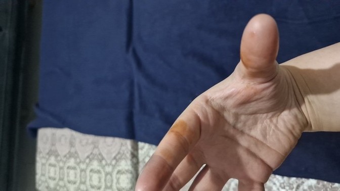 Bu lekeler nedir?