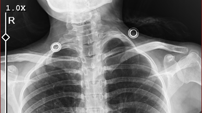 Boynumun sol tarafına dokununca bi sertlik var doktor fazladan kemik var dedi nasıl olabiliyor bu?