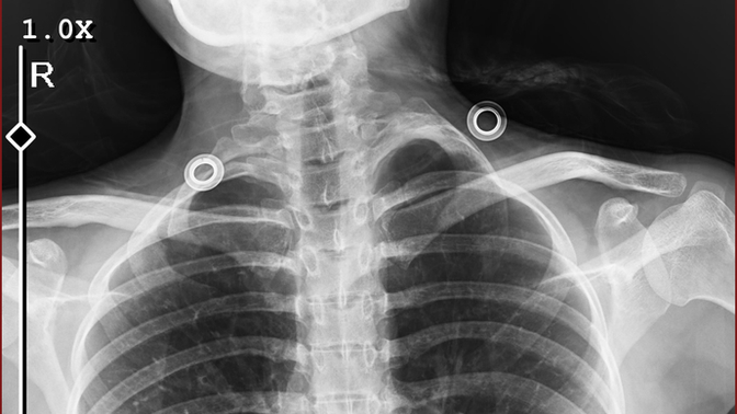 Boynumun sol tarafına dokununca bi sertlik var doktor fazladan kemik var dedi nasıl olabiliyor bu?