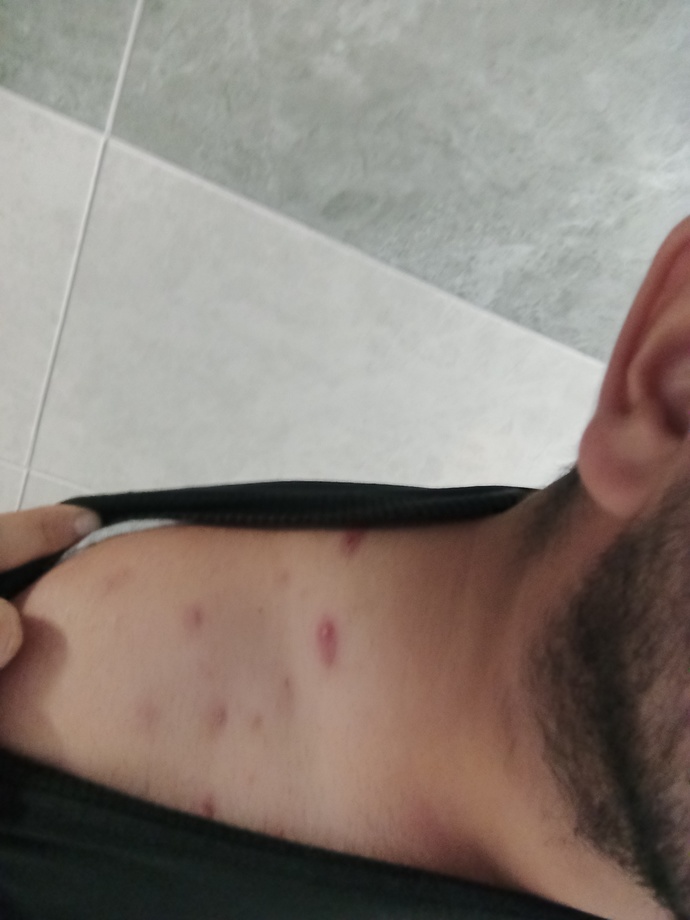 Sivilce mi bu ne sivilcesi?