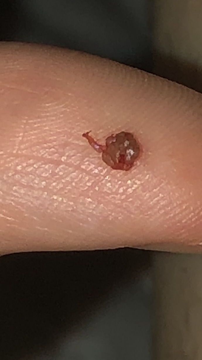 Makat bölgemde böyle bir şey vardı ve ben kestim. Daha önce başına gelen var mı? Bu HPV mi ölümcül mü ilişkide yaşamadım?