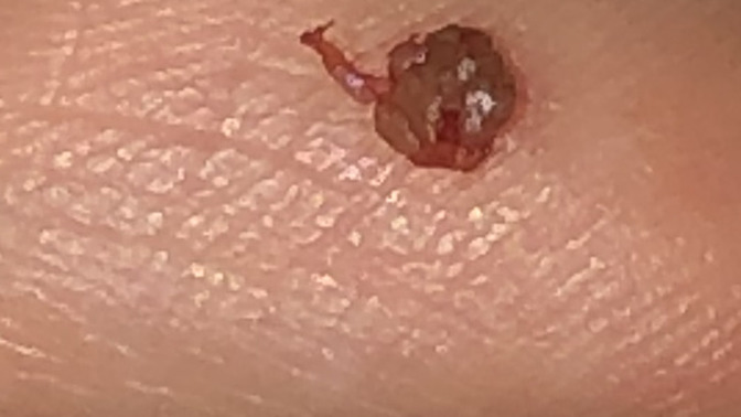 Makat bölgemde böyle bir şey vardı ve ben kestim. Daha önce başına gelen var mı? Bu HPV mi ölümcül mü ilişkide yaşamadım?
