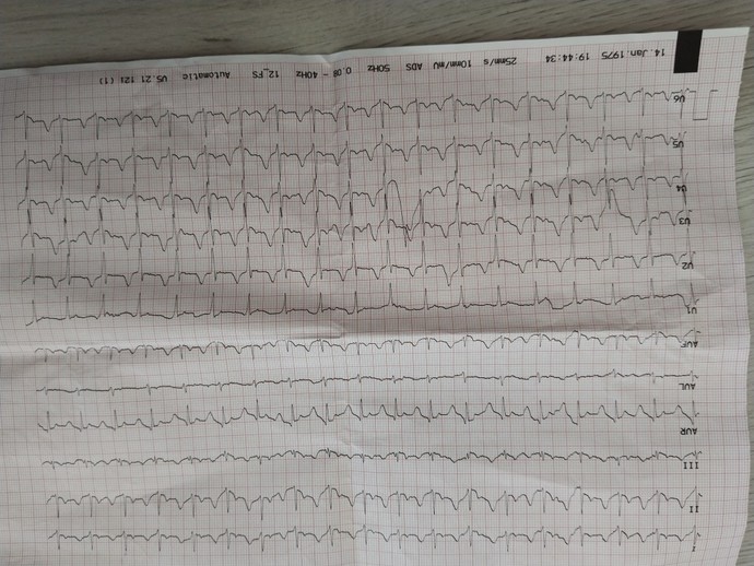 EKG sonucuma bakar mısınız acilll?