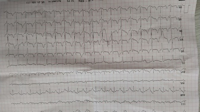 EKG sonucuma bakar mısınız acilll?