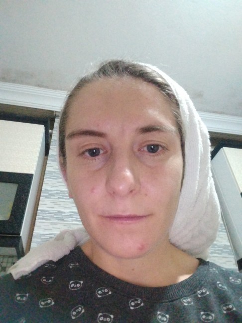 Selam, sivilcem kötümü?