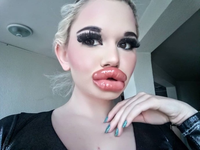 Kadınların istediği dudak dolgusu böyle bir şey mi?