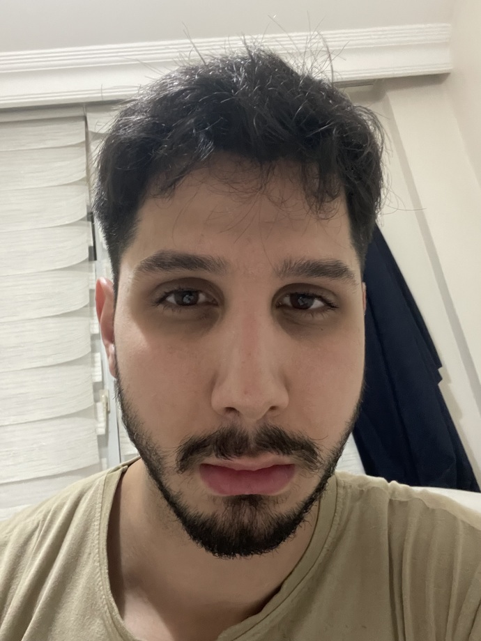 Göz altı morluğum nasıl geçer?