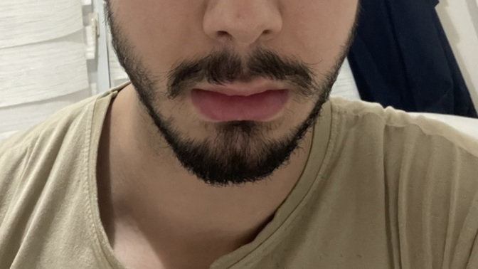 Göz altı morluğum nasıl geçer?