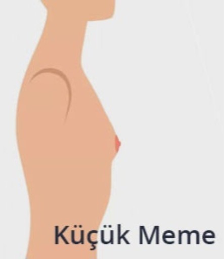 Göğüslerim bu şekil, evlilikte sorun olur mu?