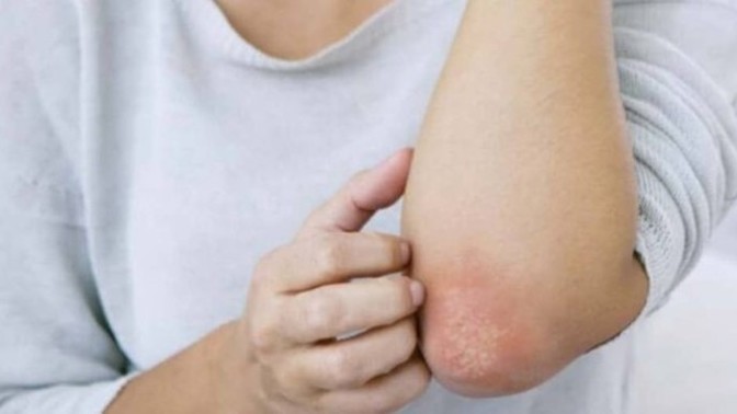 Sedef hastalığı (psoriasis) hakkında ne kadar bilgi sahibisiniz?