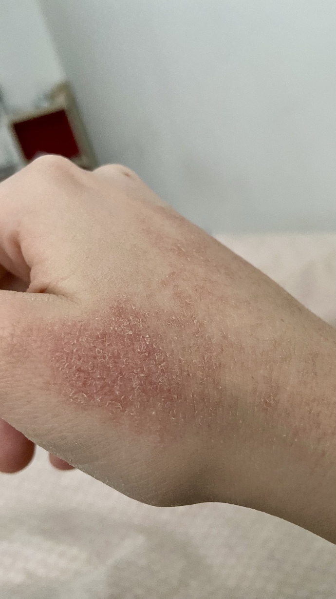 Ben sivilce için zoretanin ilaçı kullanıyorumda kollarım ellerim resimdeki gibi oldu normal mi acaba?