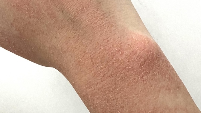 Ben sivilce için zoretanin ilaçı kullanıyorumda kollarım ellerim resimdeki gibi oldu normal mi acaba?