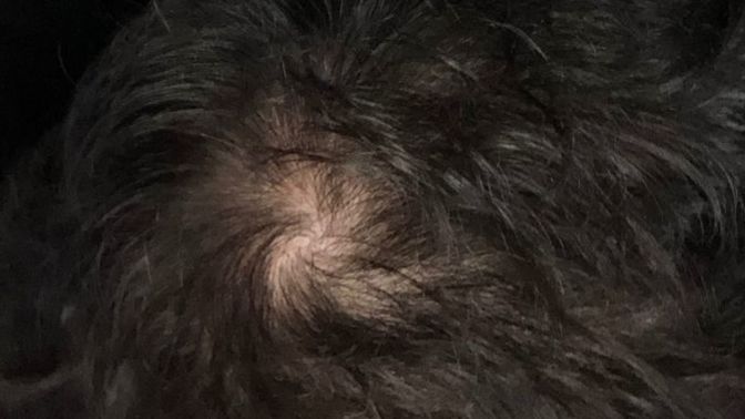18 yaşındayım, kafamın tepesi böyle. Bu normal mi yoksa saç seyrelmesi mi var?