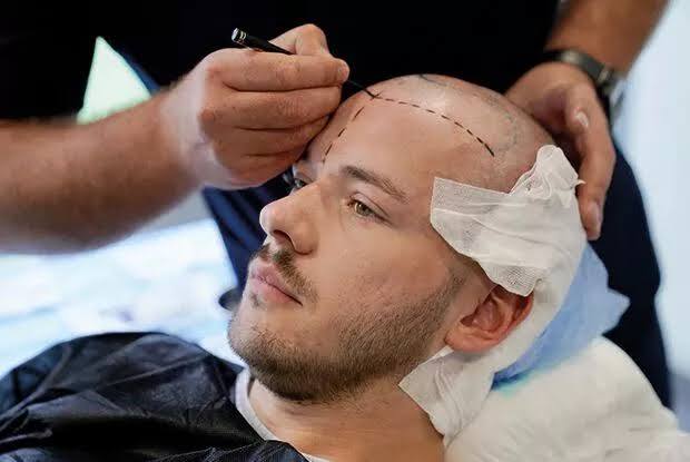 Saç ekimi yaptırmak tehlikeli mi?