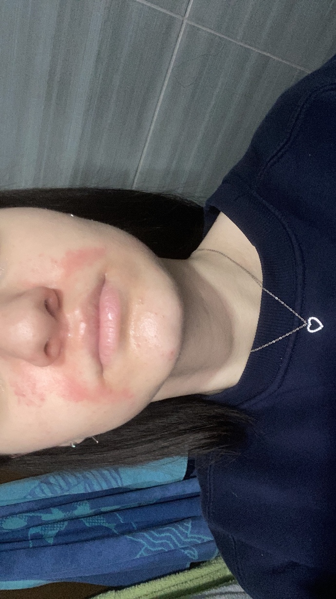 Yüz egzaması için doktora gitmeli miyim?