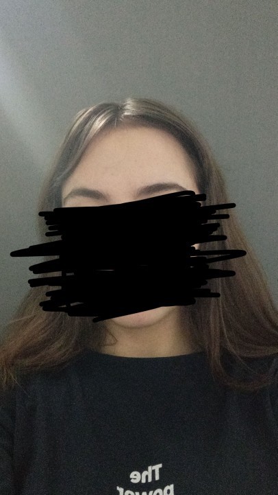 Alnımda brbek saçı için kullandığım ürün sivilce yapıyor nedeni nedir?