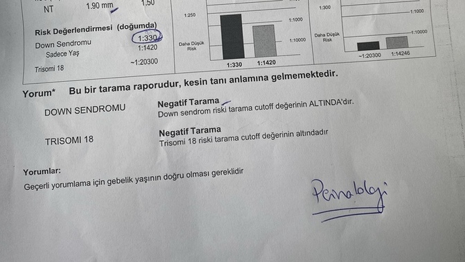 Dowm sendrom var mı?
