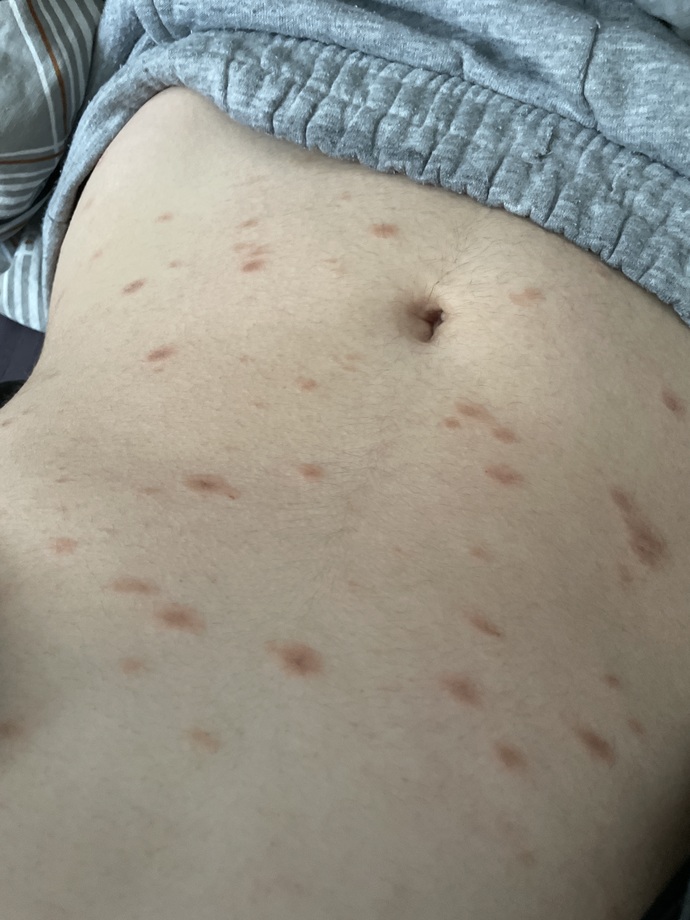 bu sekilde kizarik kuru ve kasiniyor doktor tespit edemedi alerji hapi verdi her yerinde var nerdeyse ama en cok bu gobegimde var