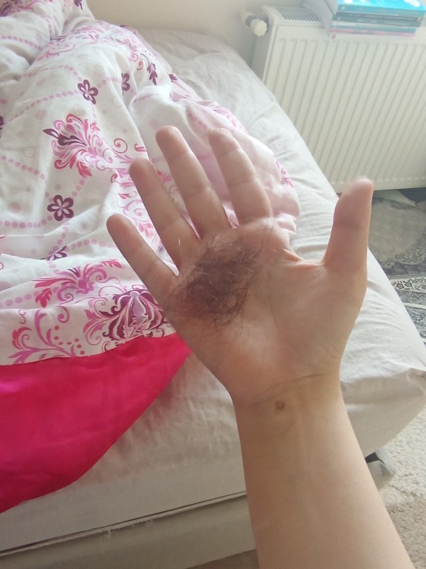 Bu saç dökülmesi normal mi?