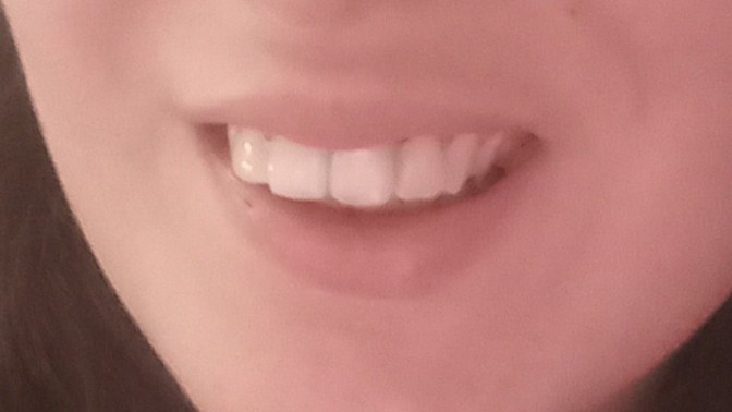 Bu dişler nasıl size göre?