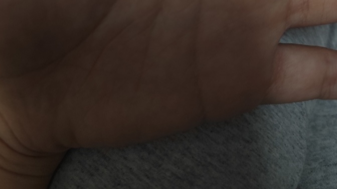 Vücudum aşırı kaşınıyor ve elimdeki damarlar morardı, sizce zehirlenmiş miyimdir yoksa bir şey mi alerji yapmıştır?