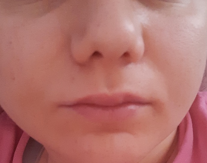 Bugün dudağıma dolgu yaptırmak istiyorum, gerek var mı sizce de?