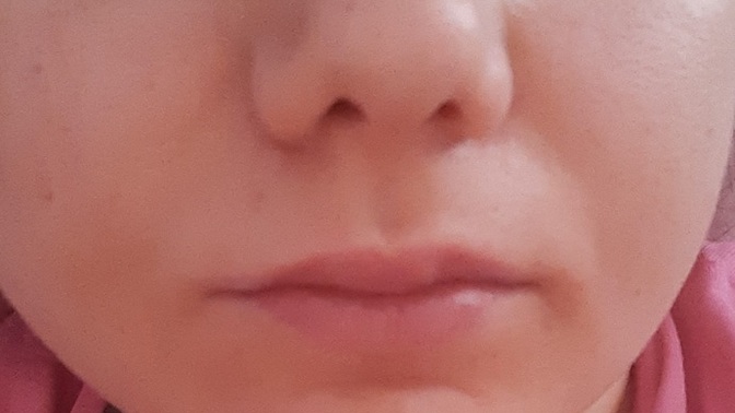 Bugün dudağıma dolgu yaptırmak istiyorum, gerek var mı sizce de?