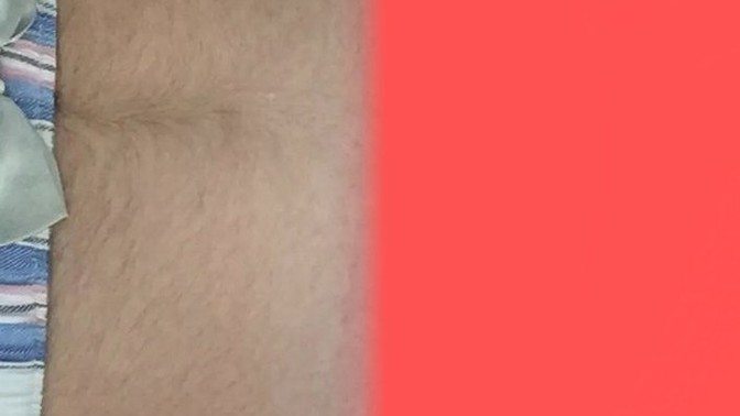 Çok mu kıl var vücudumda? Ve nasıl giderebilirim?