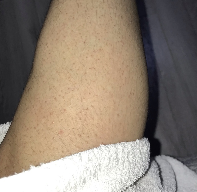 Şu bacağıma bakın arkadaşlar… bıktım artık bu görüntü nasıl gider ve pürüzsüz bacaklara sahip olabilirim peeling yapıyorum buarada?