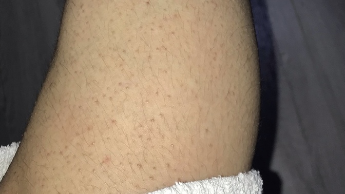 Şu bacağıma bakın arkadaşlar… bıktım artık bu görüntü nasıl gider ve pürüzsüz bacaklara sahip olabilirim peeling yapıyorum buarada?
