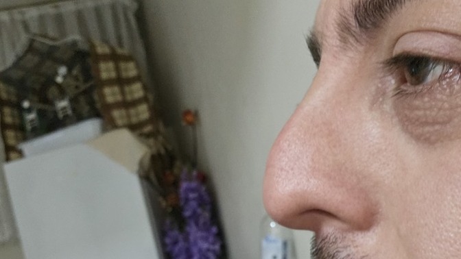 Bu burnun estetiğe ihtiyacı var mı?