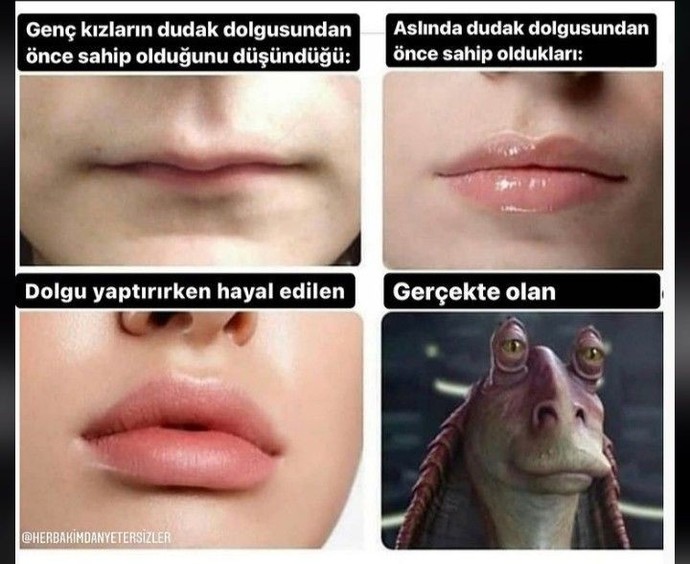 Dudak dolgusu bilgisi olan var mı?