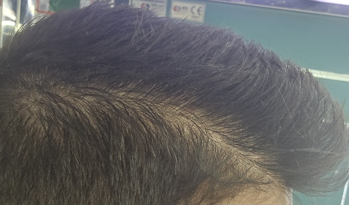 Saç dökülmesi sorunu?
