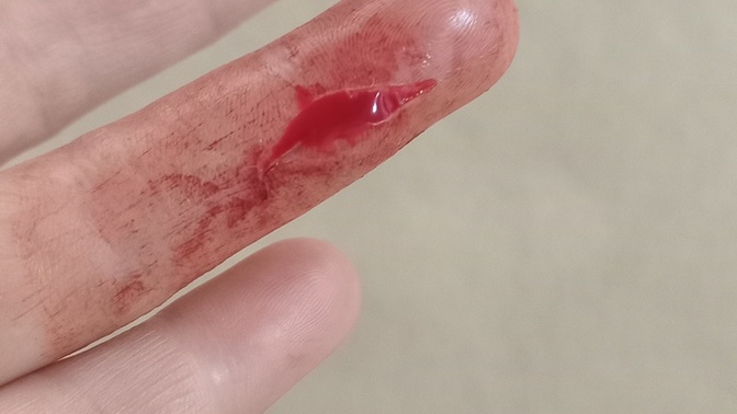 Elimi kestim arkadaşlar, dikiş atılmasına gerek var mı?