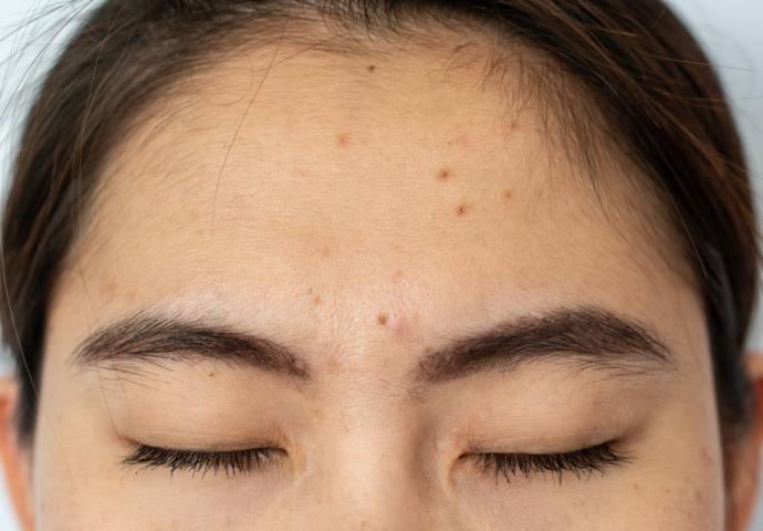 Kahkül sivilce yapar mı?