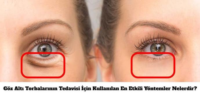 Göz altı torbaları nasıl geçer?